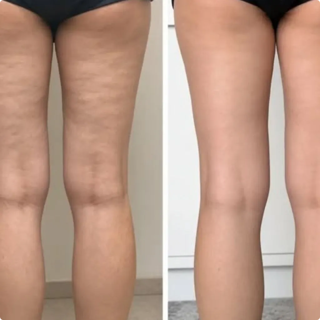 Endolift Laser for Lipedema