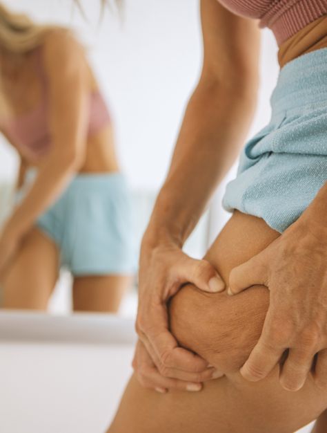 Endolift for Cellulite