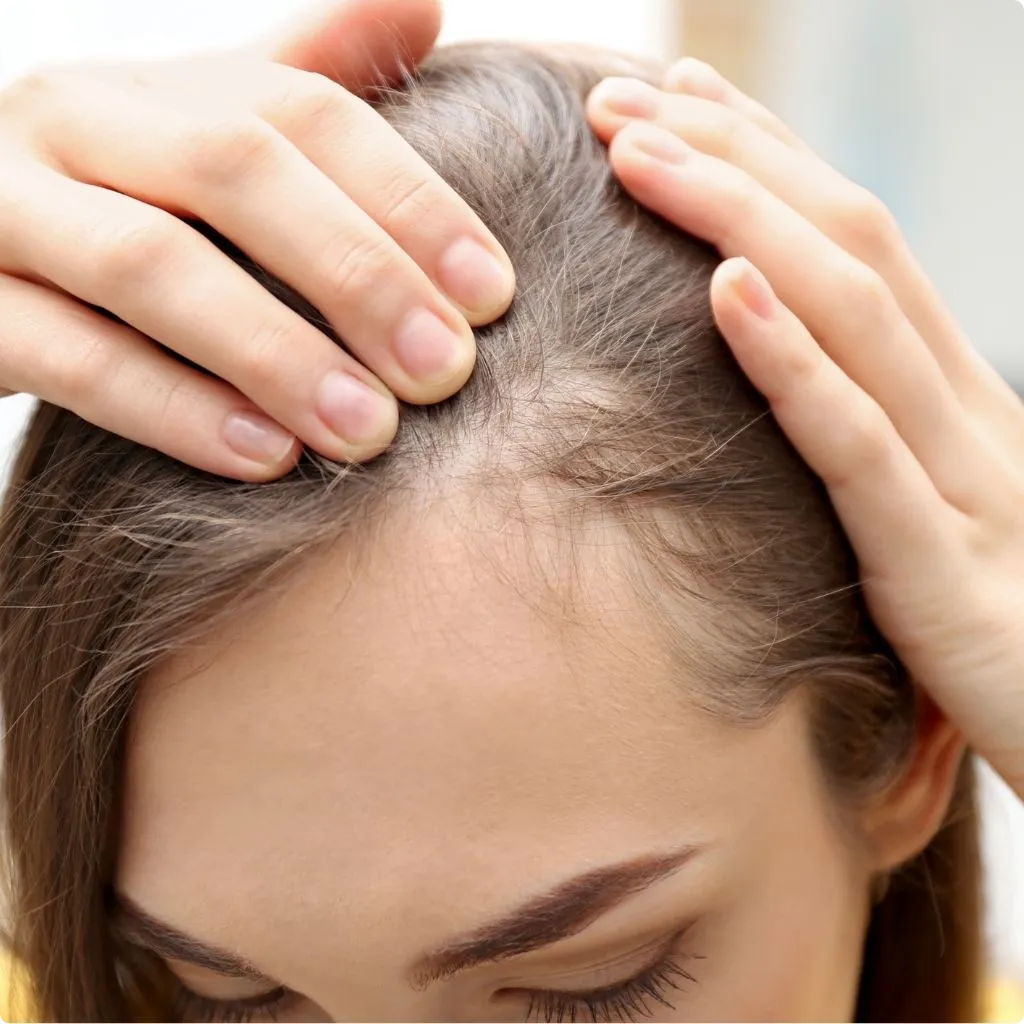 Hair Fall After Pregnancy