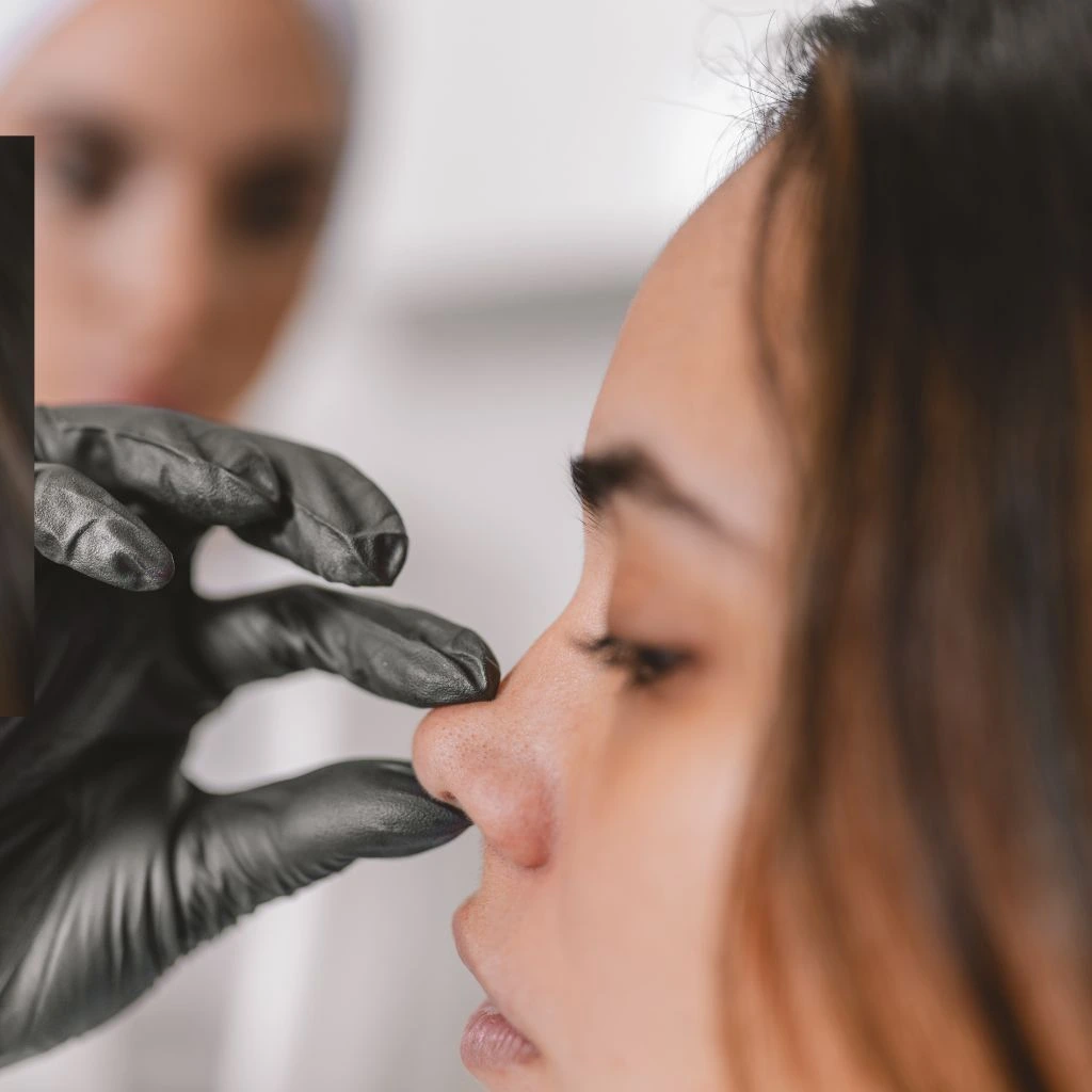Hyaluronic acid nose treatment