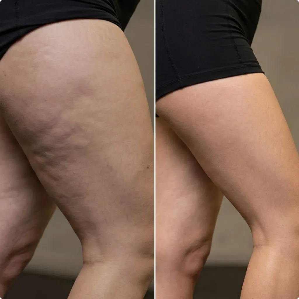 Individual's thigh after Endolift cellulite reduction results