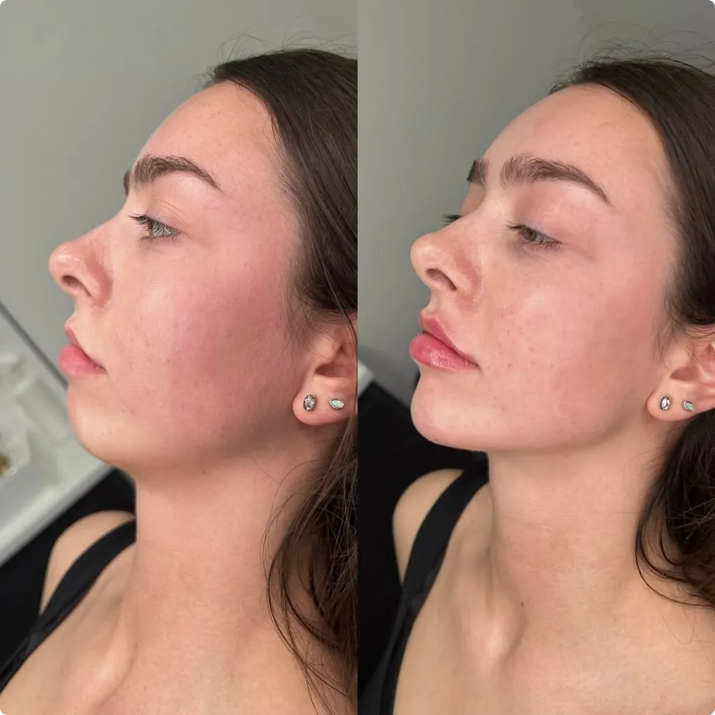 Before and after results of jawline filler