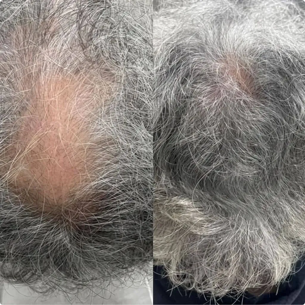 MCT treatment result before and after