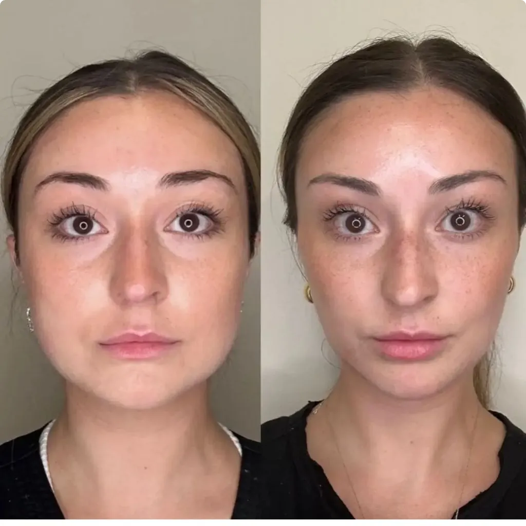 Masseter Botox results Dubai (2)