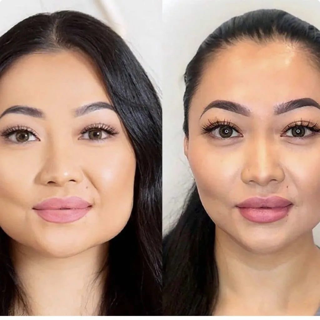 Masseter Botox results Dubai