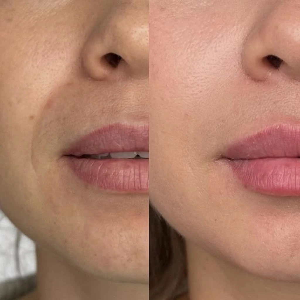 Natural lip enhancement before and after PRF