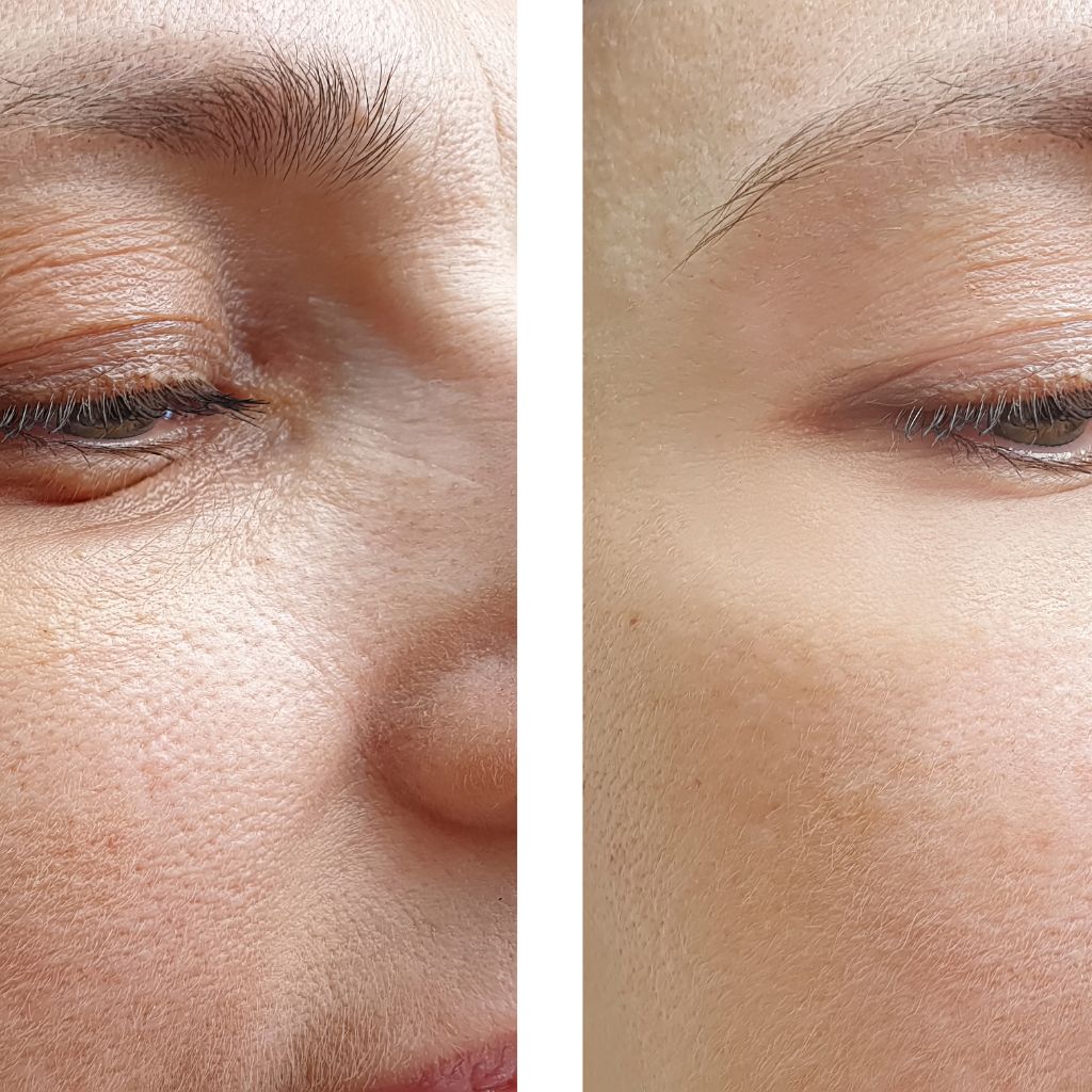 PRF Treatment for Face