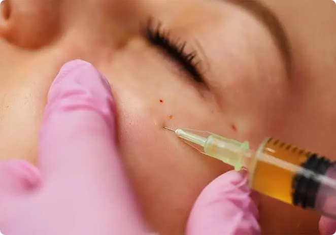 PRF Treatment in Dubai