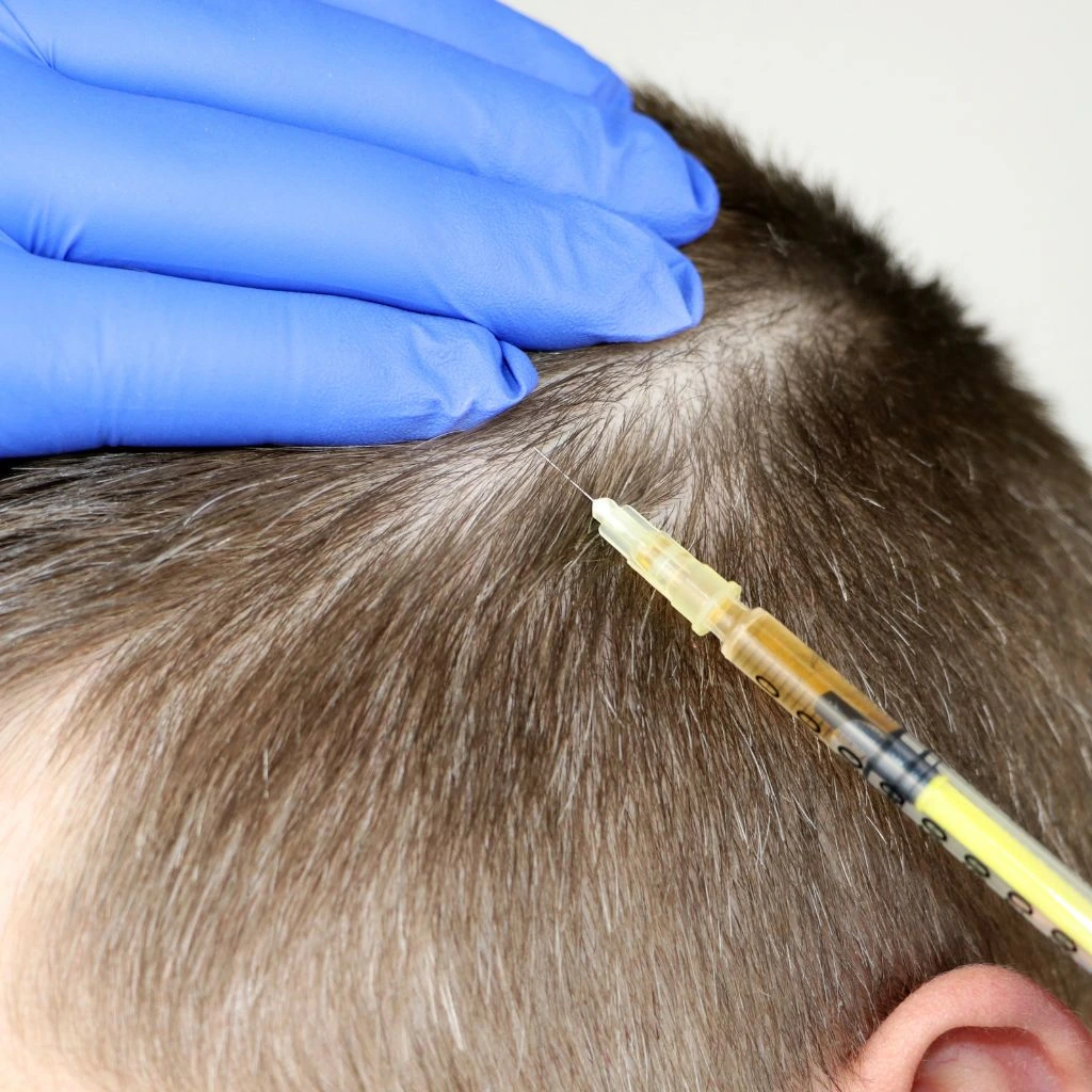 PRP Hair Injection