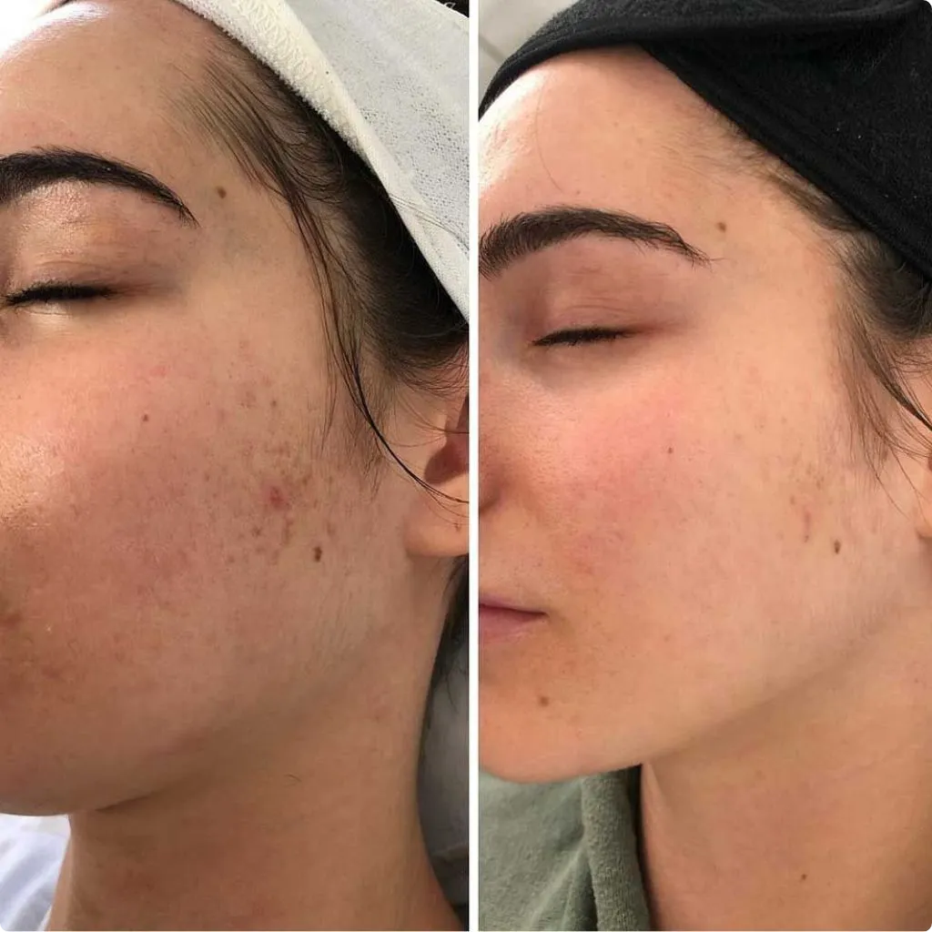 PRP facial rejuvenation results Dubai