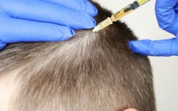 PRP hair treatment cost in Dubai