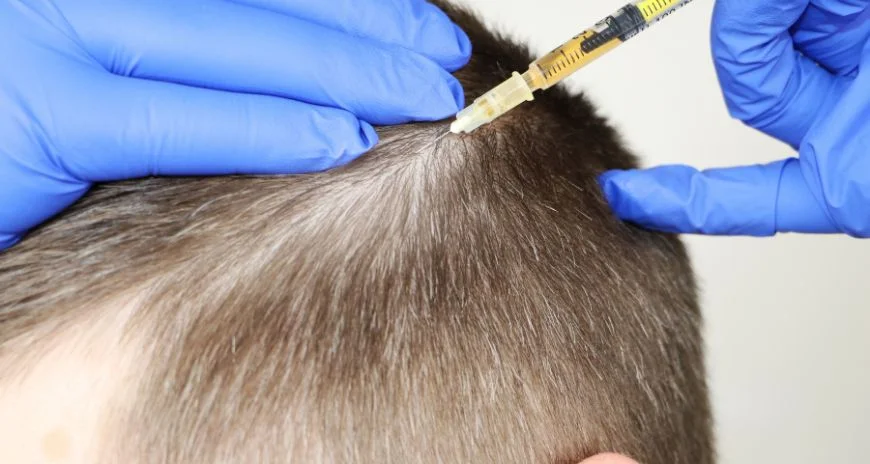 PRP hair treatment cost in Dubai