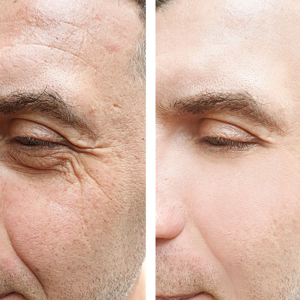 Patient's face before PRF treatment