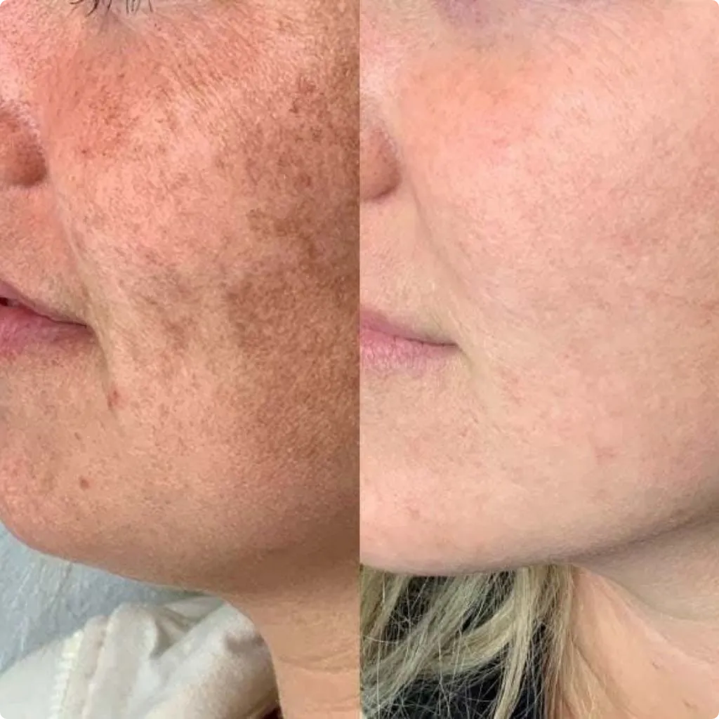 Pigmentation treatment before and after results Dubai