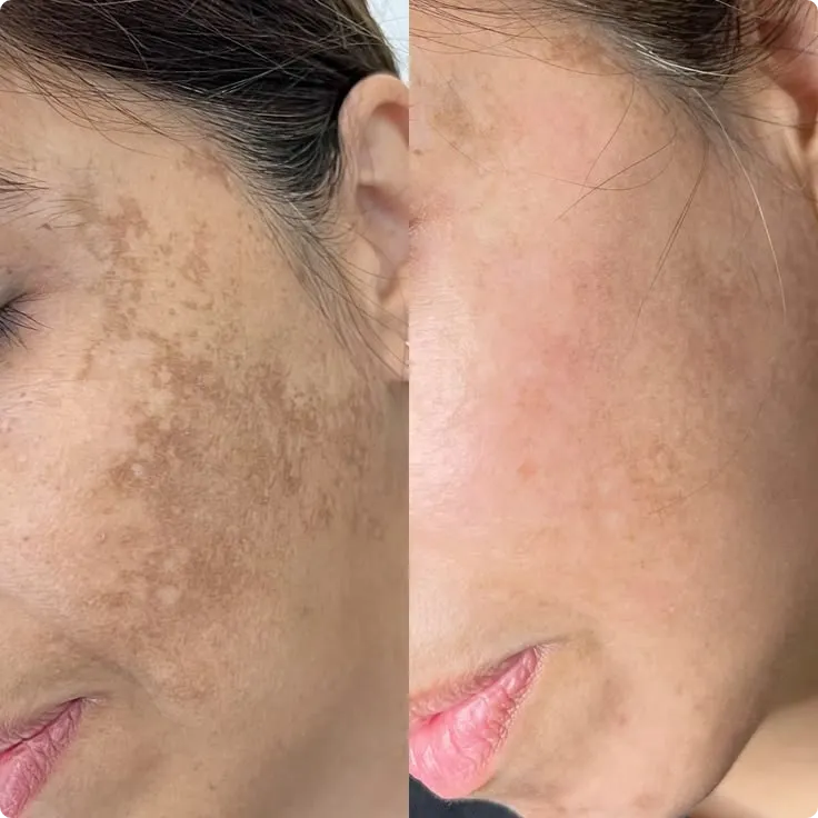 Pigmentation treatment before and after – clearer skin