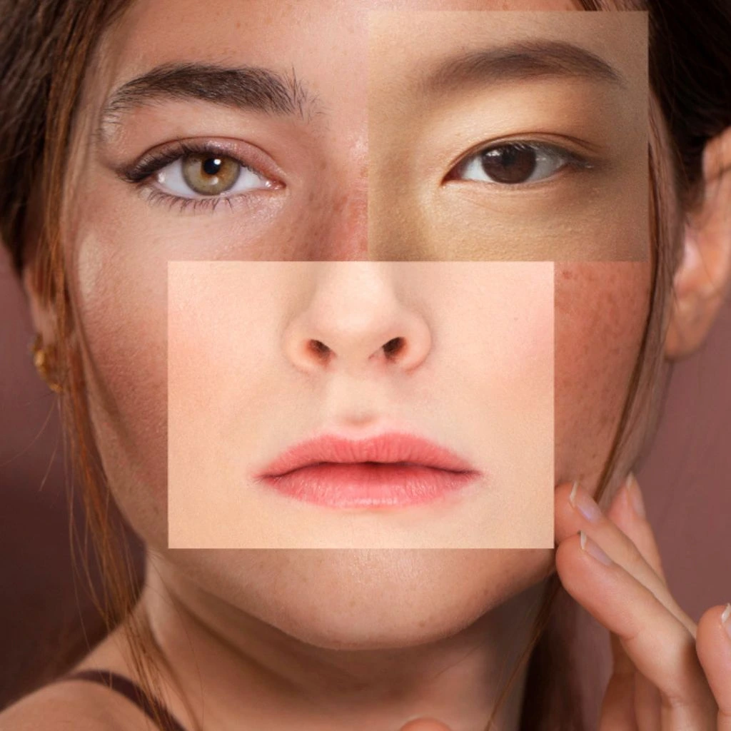 Skin Pigmentation Treatment in Dubai