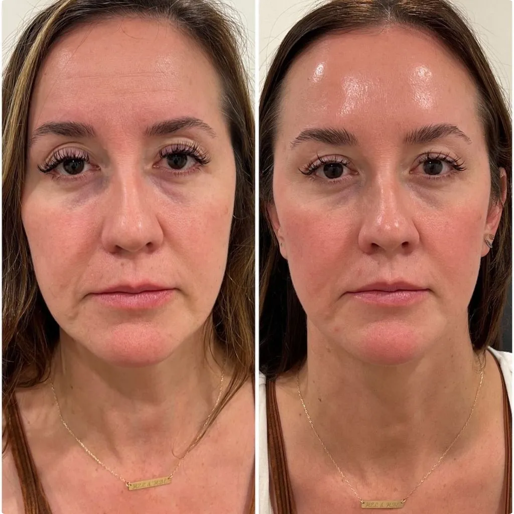 Skin booster before and after results Dubai