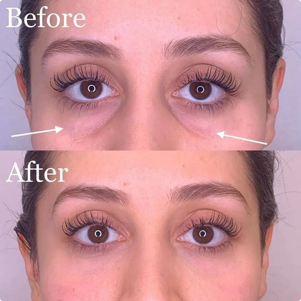Under eye filler before and after tear trough correction