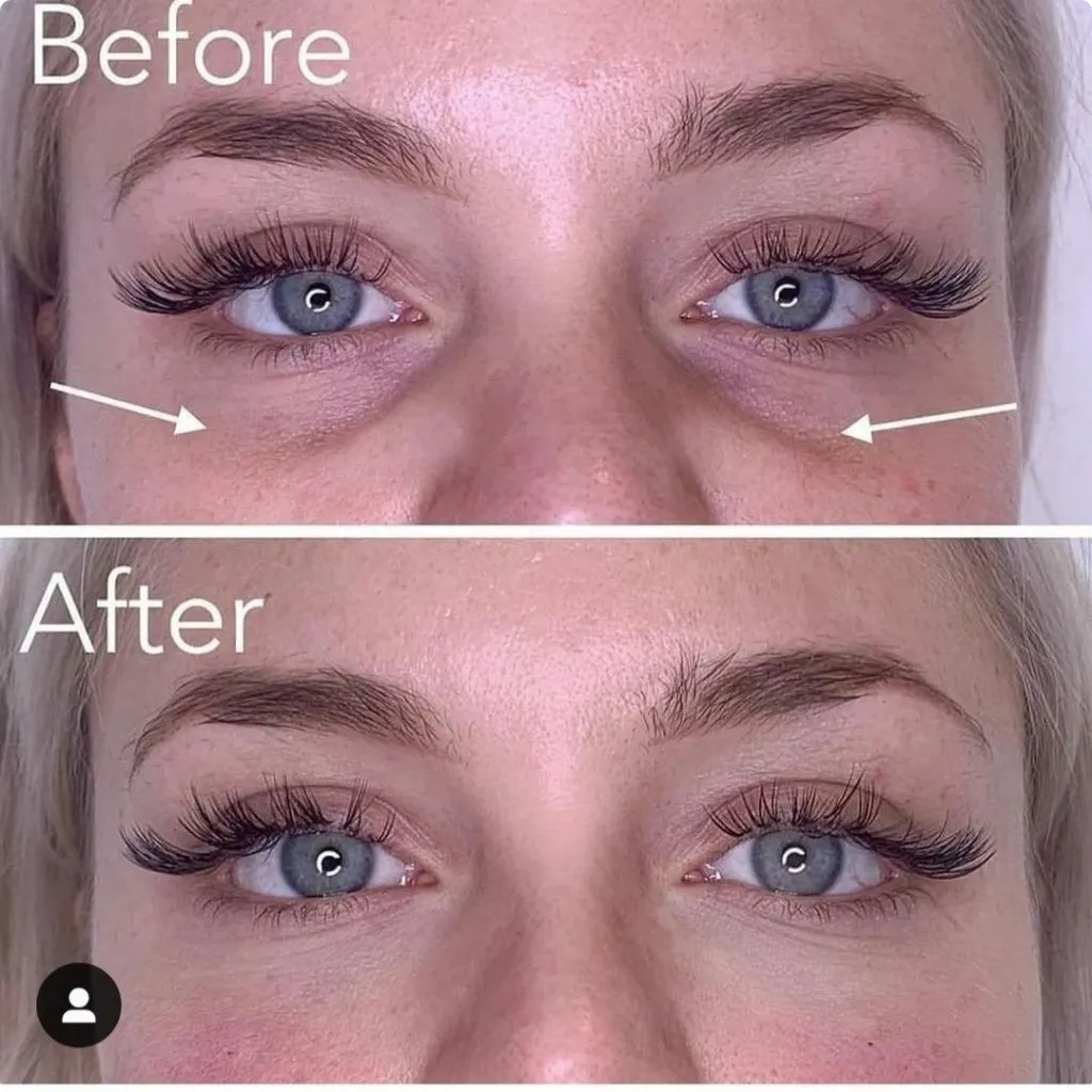 Under eye filler before and after tear trough correction