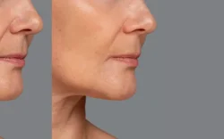 jawline filler before and after