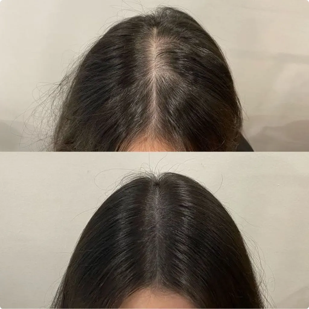 platelet-rich plasma therapy