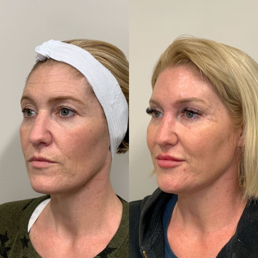 Before and after Sculptra filler results