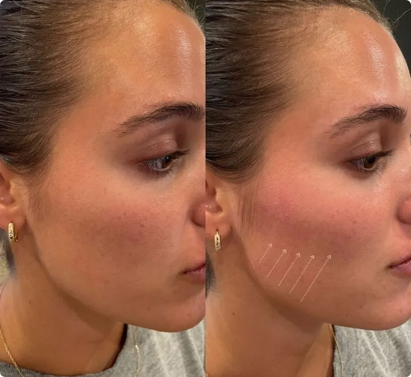 Natural cheek filler results before and after