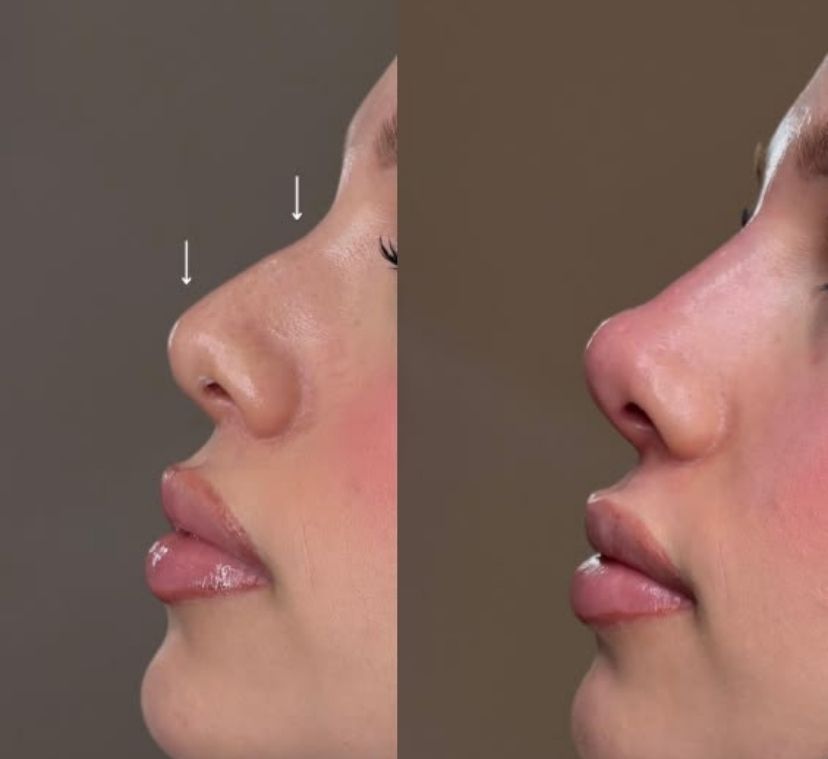Before and after nose fillers
