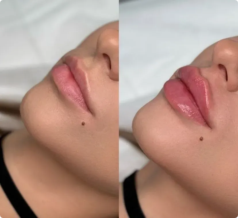 Lip filler before after photo