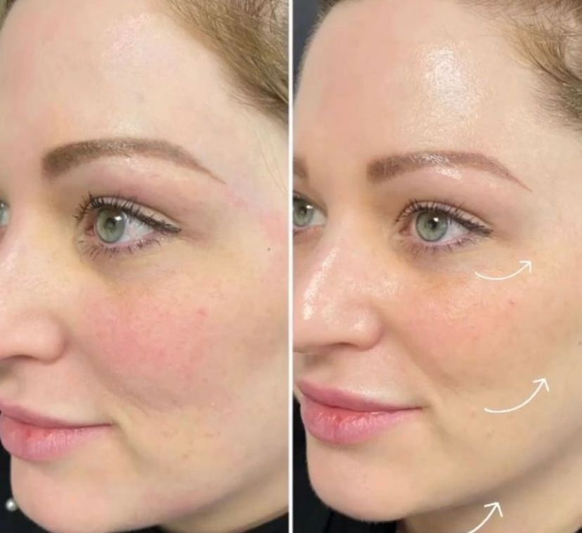 Natural cheek filler results before and after
