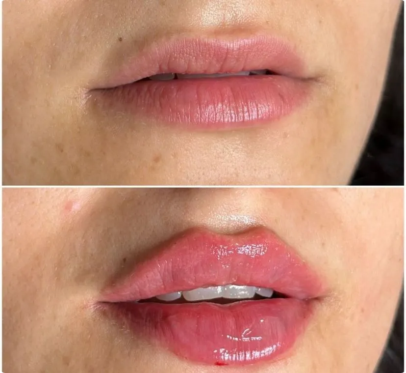 Lip filler before after photo