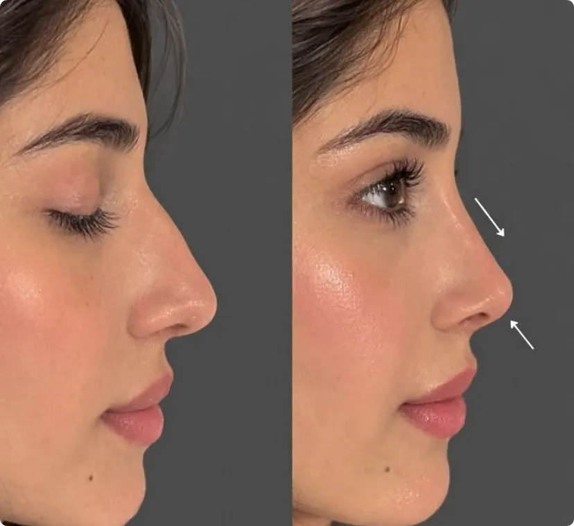 Non-surgical nose job before and after