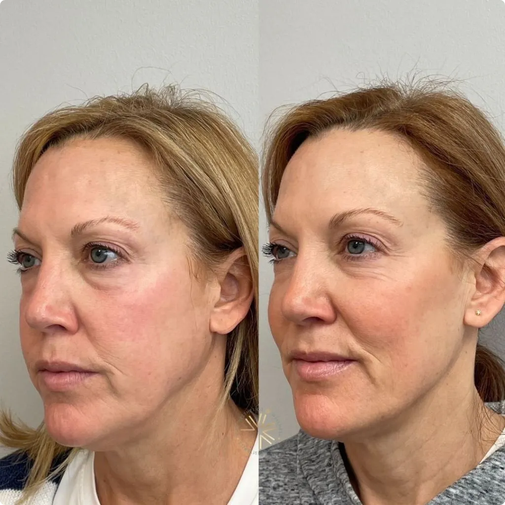 Sculptra filler before and after photo showing facial volume restoration