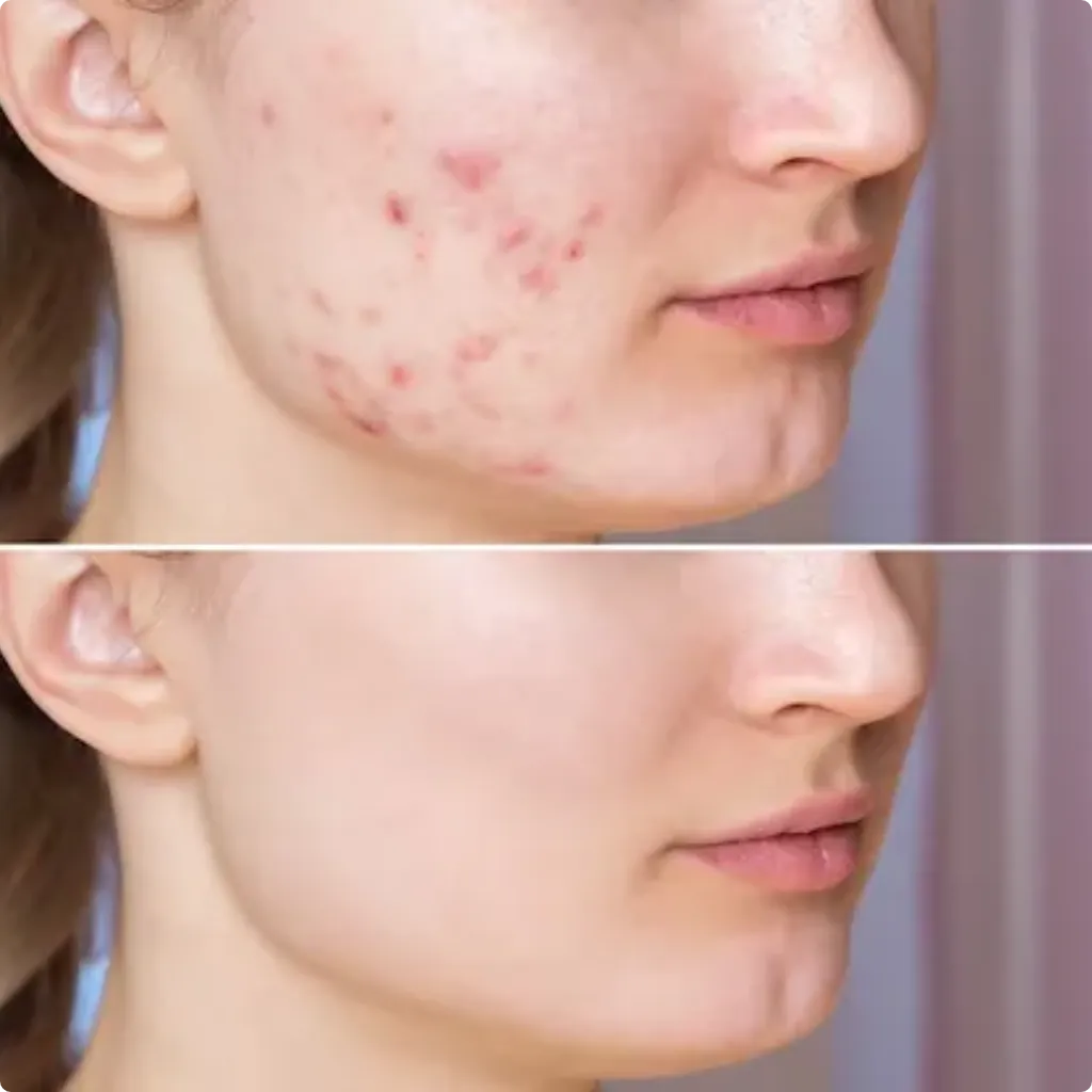 Benefits of the Hollywood Spectra Laser