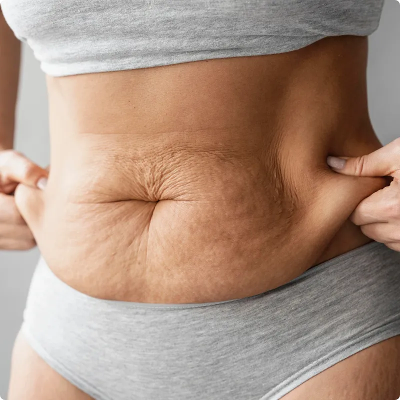 Post Liposuction Fibrosis Treatment